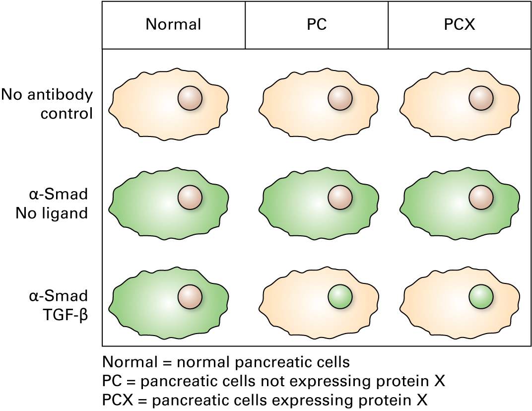 Immunofluorescence using fluorescein-conjugated antibodies for Smad shows the following: Normal pancreatic cells in the absence of ligand: green fluorescence in the cytosol of the cell Pancreatic cells not expressing protein X in the absence of ligand: green fluorescence in the cytosol of the cell Pancreatic cells expressing protein X in the absence of ligand: green fluorescence in the cytosol of the cell Normal pancreatic cells in the presence of TGF-β: green fluorescence in the cytosol of the cell Pancreatic cells not expressing protein X in the presence of TGF-β: green fluorescence in the nucleus of the cell Pancreatic cells expressing protein X in the presence of TGF-β: green fluorescence in the nucleus of the cell 