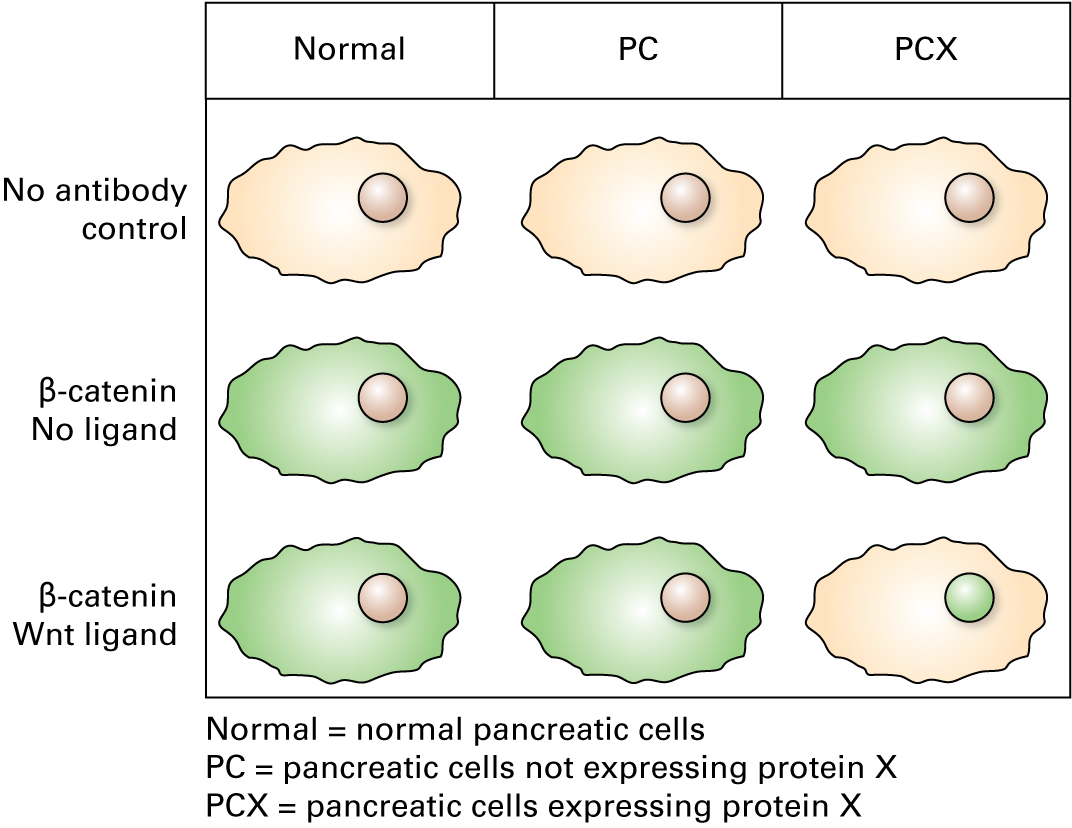 Immunofluorescence using fluorescein-conjugated antibodies for β-catenin shows the following: Normal pancreatic cells in the absence of ligand: green fluorescence in the cytosol of the cell Pancreatic cells not expressing protein X in the absence of ligand: green fluorescence in the cytosol of the cell Pancreatic cells expressing protein X in the absence of ligand: green fluorescence in the cytosol of the cell Normal pancreatic cells in the presence of Wnt ligand: green fluorescence in the cytosol of the cell Pancreatic cells not expressing protein X in the presence of Wnt ligand: green fluorescence in the cytosol of the cell Pancreatic cells expressing protein X in the presence of Wnt ligand: green fluorescence in the nucleus of the cell 